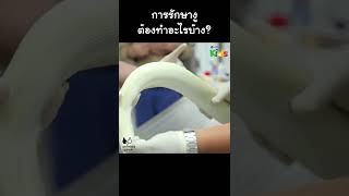 การรักษางู ต้องทำอะไรบ้าง? #Shorts